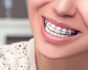 Kahvenin ağzını kesinlikle kapalı tutunuz 2 Ortodonti randevusu nasıl alınır ?